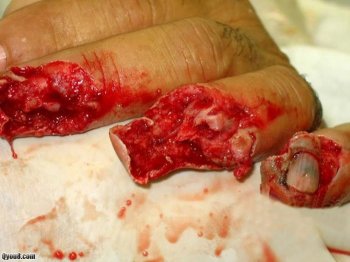 意外绞碎的手指-恐怖血肉模糊