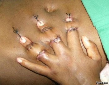 受伤的手指被植入腹部