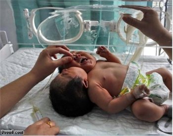 罕见的双头女婴