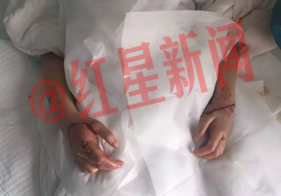 “江西11岁女孩双手被砍断”续：现已接上 手指能动