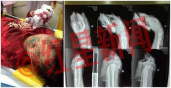 “江西11岁女孩双手被砍断”续：现已接上 手指能动