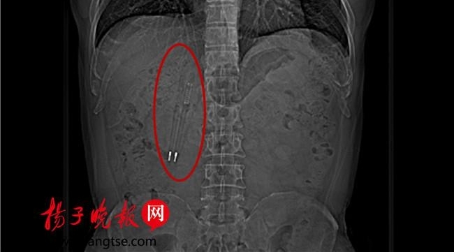 圆珠笔吞进体内36年后取出 竟是因为跟朋友喝酒打赌