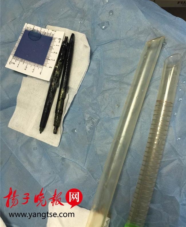 圆珠笔吞进体内36年后取出 竟是因为跟朋友喝酒打赌