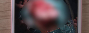 12岁女孩肚子大如孕妇 经查发现为卵巢癌晚期