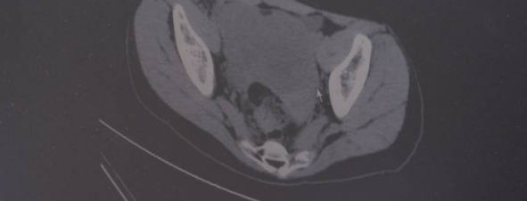 12岁女孩肚子大如孕妇 经查发现为卵巢癌晚期