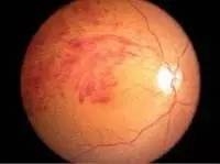 IT男因躺着玩手机致盲 医生说是患上了“暴盲症”