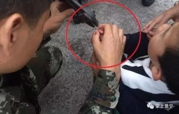 8岁儿童贪玩被戒指“锁”手，家长一个劲急啊