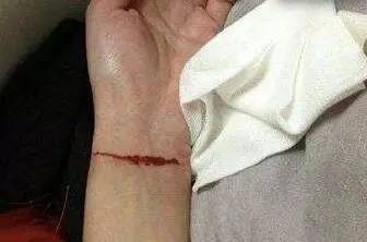 杭州一姑娘失恋割腕 闺蜜竟陪着一起割