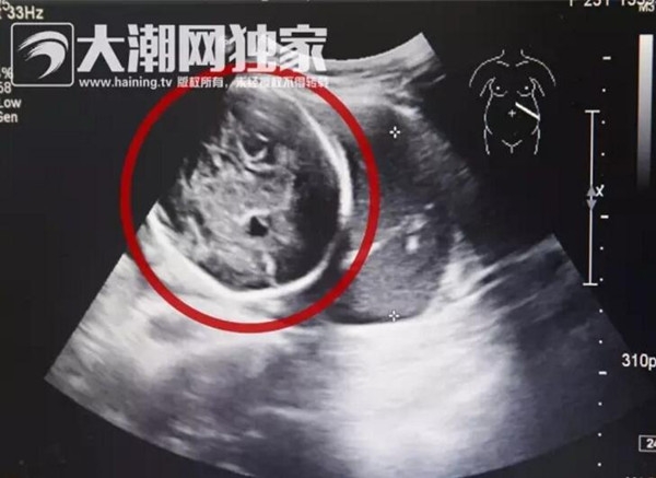 孩子去哪了？浙江女子怀孕6个多月 子宫却是空的