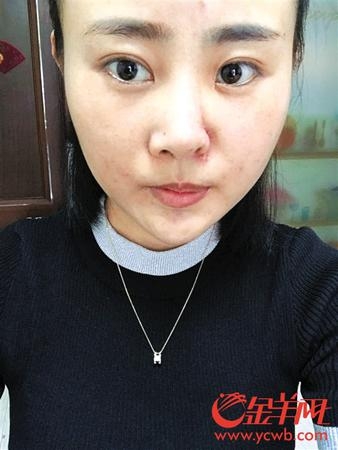 丽江被打毁容女孩：医生说疤痕花100万都恢复不了