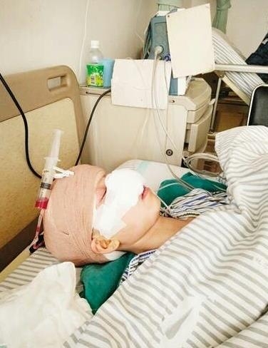 女子离婚后被前夫咬掉鼻子 施暴者一审获刑六年