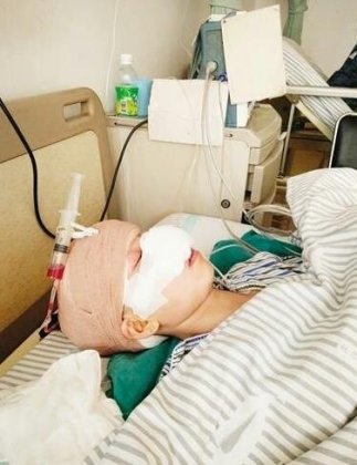 女子离婚后被前夫咬掉鼻子 施暴者一审获刑六年