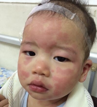 小儿荨麻疹如何治疗 小儿荨麻疹是否传染