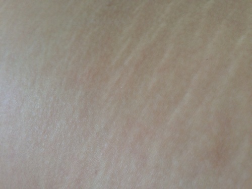 肥胖纹图片 肥胖纹怎样治疗