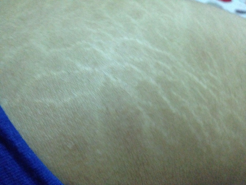 肥胖纹图片 肥胖纹怎样治疗