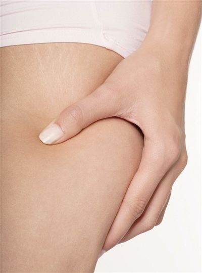 肥胖纹图片 肥胖纹怎样治疗